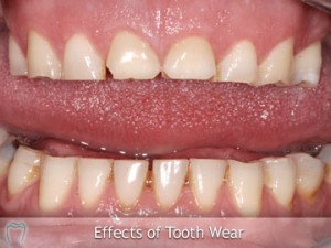treatment to stop teeth grinding
