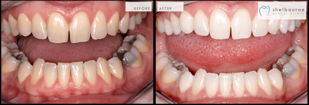 bad teeth before and after pictures