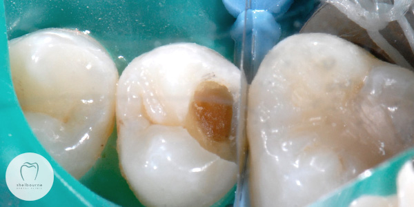 Dental Decay