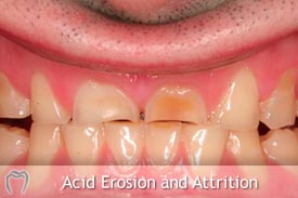 Acid Erosion