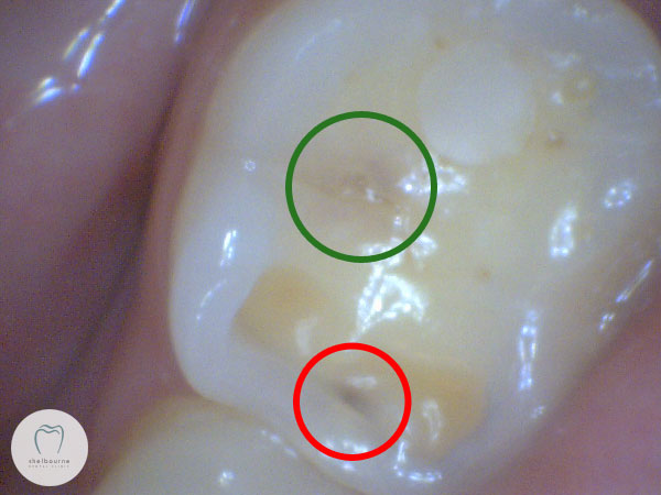 Photo of tooth in 2009