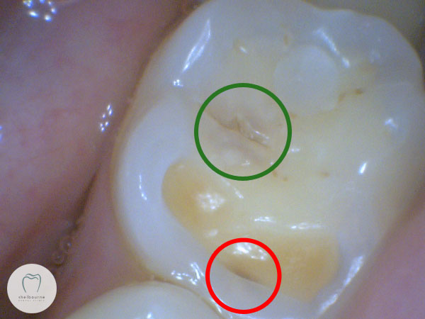 Photo of tooth in 2013