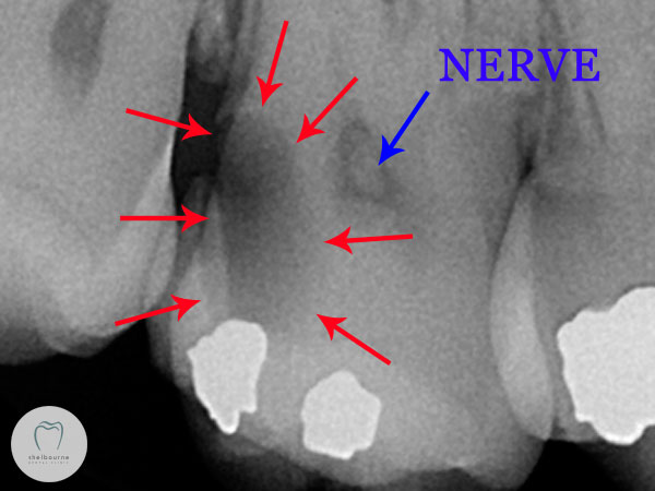 Xray of tooth decay