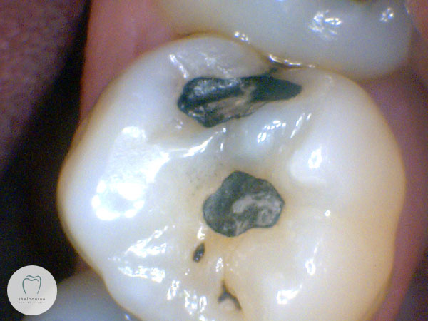 Photo of the tooth before treatment
