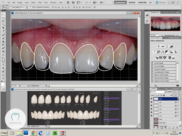 Digital Smile Design for cosmetic bonding case