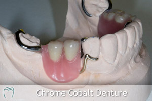 Chrome Cobalt Denture