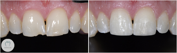 Cosmetic Bonding to fix chipped teeth