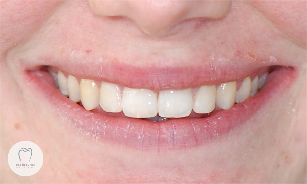 Cosmetic Bonding - Results