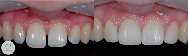 Improving appearance using dental bonding