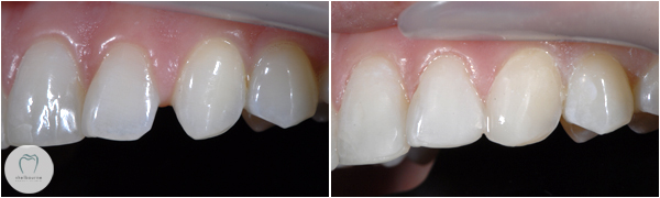 Closing gaps using dental bonding