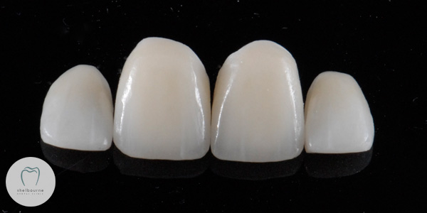 New crowns and veneers