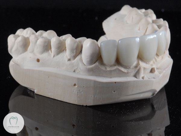 New crowns and veneers