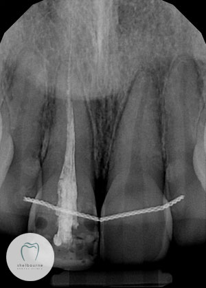 Poor Root Canal Treatment