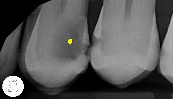 Dental X-ray of a large cavity with risk of root canal