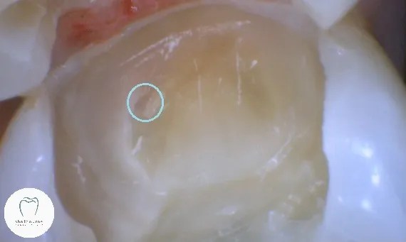 Tooth nerve almost exposed which could result in root canal 