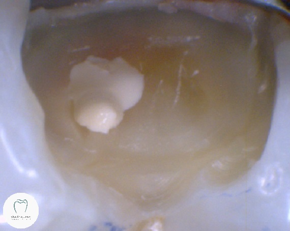 Antibacterial layer applied over nerve in tooth to try avoid root canal