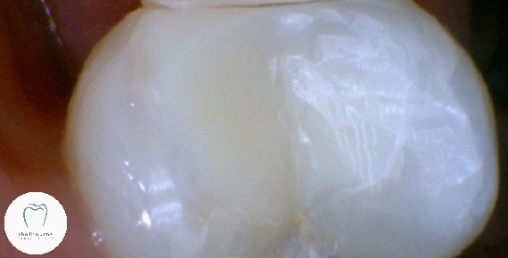 The tooth finally filled with no root canal needed