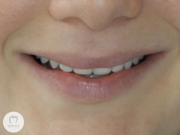Final new smile