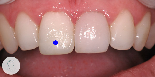 Toothache from upper right central incisor (blue dot) tooth.