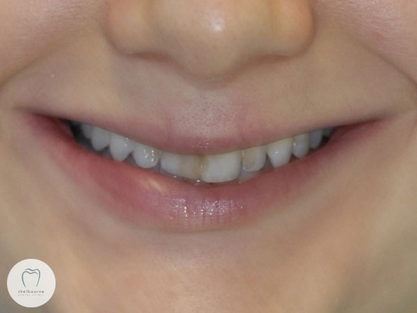 Pre-operative view of patient's smile