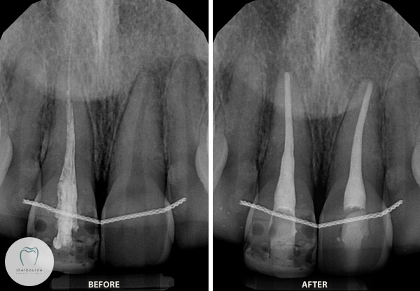 Before and After Root Canal Treatment