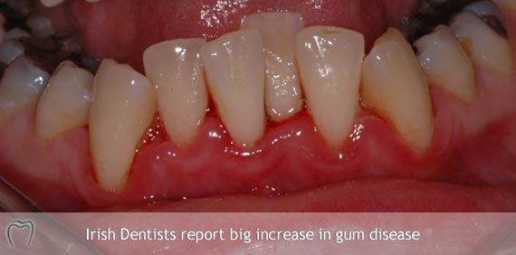 Dentists Seeing Big Increase in Gum Disease